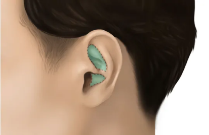 rhinoplasty_ear_donor 1