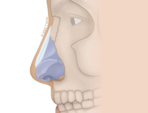 Dorsal_Augment_Dorsum