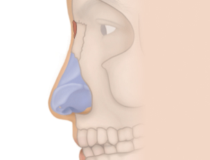Dorsal_Augment_Glabella