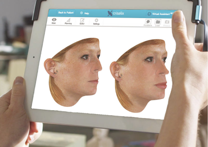 Asian Rhinoplasty &ndash; carousel