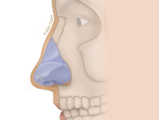 reduction-dorsal-hump#1-low nasal