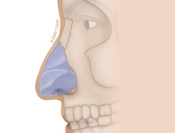 reduction-hump#2-large nose