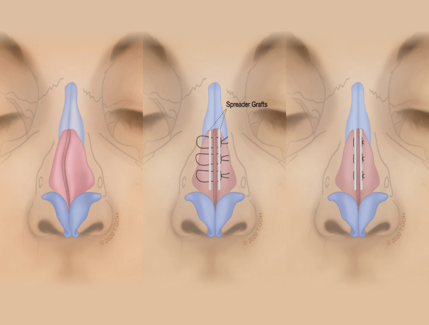 spreader_grafts-hump#3-deviated