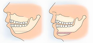 Chin Augmentation