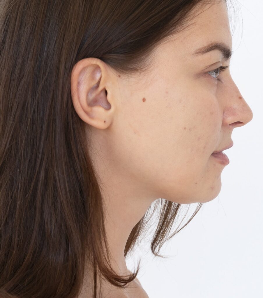 Image chin augmentation candidate