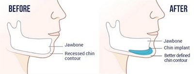 Chin Augmentation
