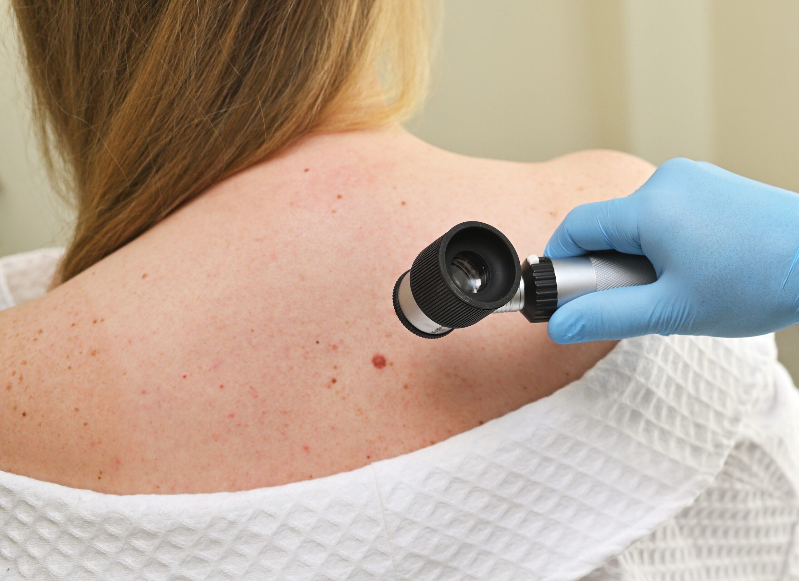Image skin cancer