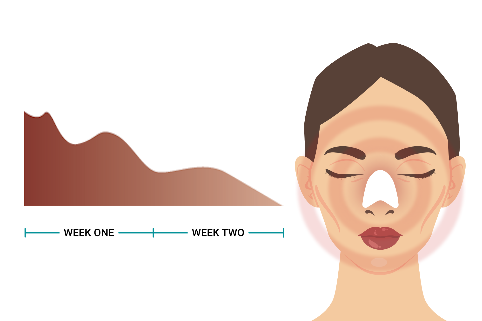 AsianRhinoplasty-ExpectAfter_Pain-Mobile