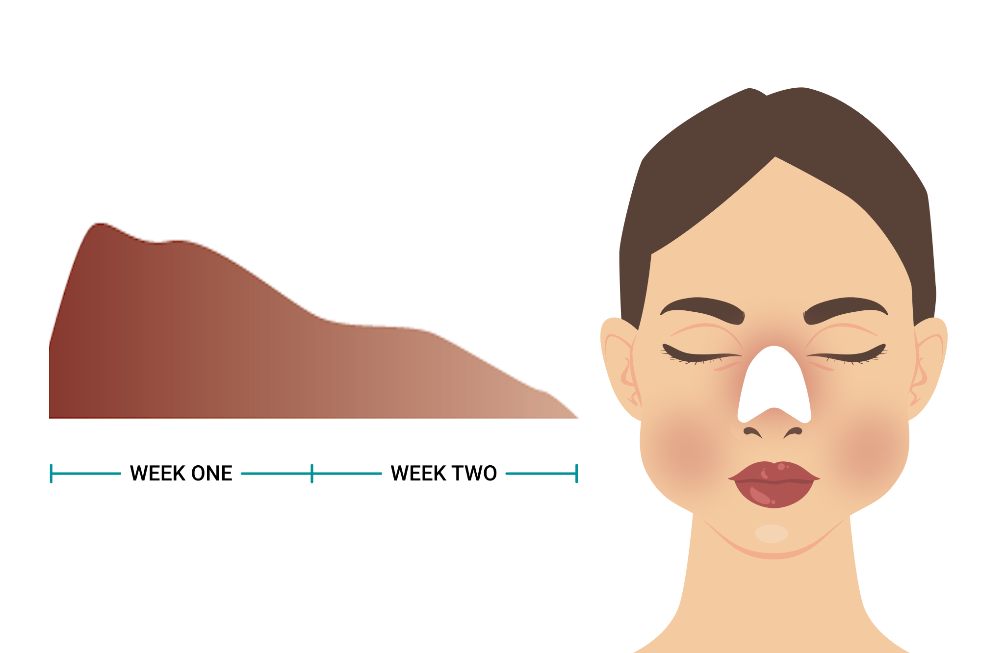 AsianRhinoplasty-ExpectAfter_Swelling-Mobile