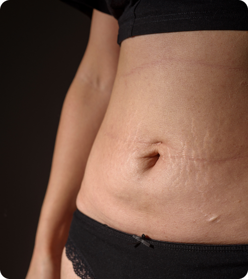 Image tummy tuck indications
