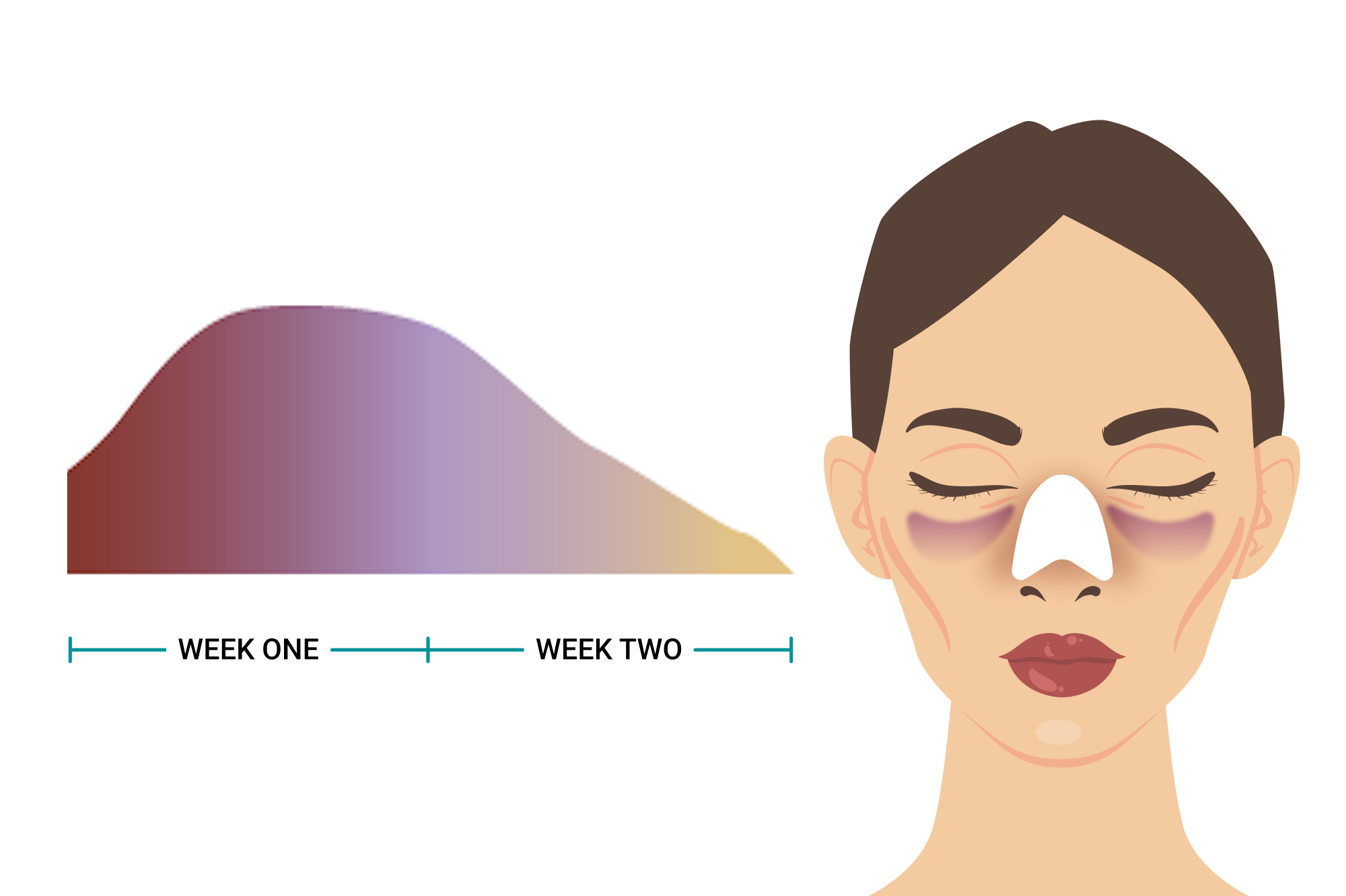 AsianRhinoplasty-ExpectAfter_Bruising