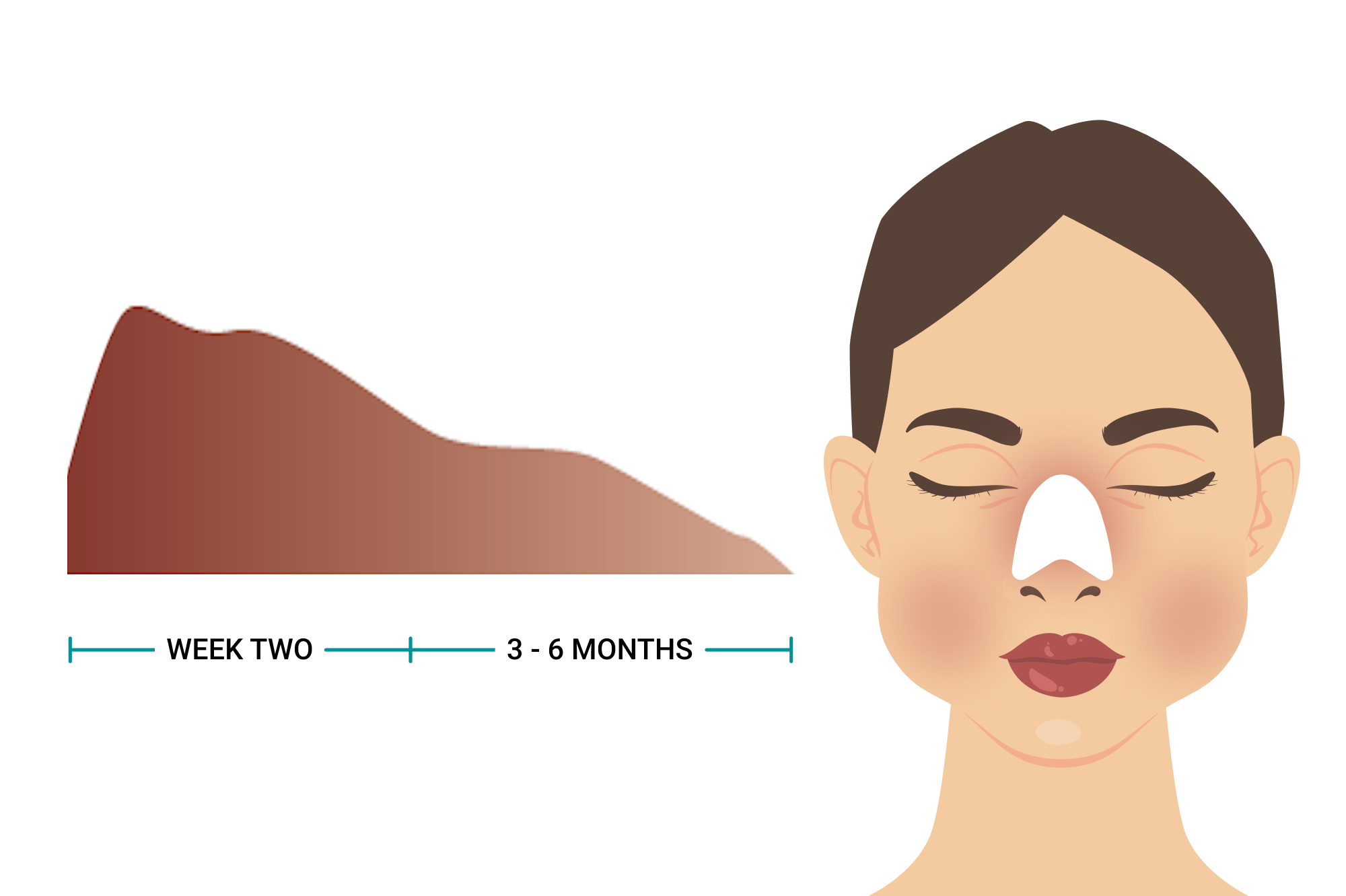 AsianRhinoplasty-ExpectAfter_Swelling